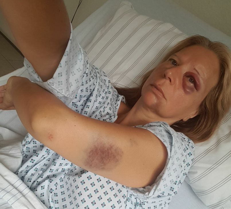 So sahen die Verletzungen von Kathrin B. aus, die ins Schleidener Krankenhaus eingeliefert werden musste. Foto: Privat